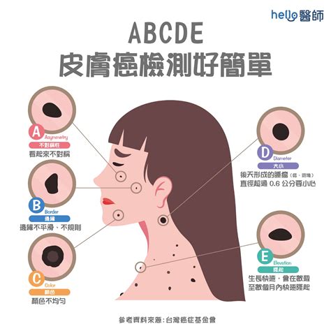 身體:acsf1ltef_m= 痣的位置|痣形成的原因？痣長毛、痣變多變大是痣病變？5招判別